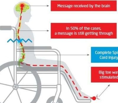 Half of spinal cord injury patients may still have some connectivity, Australian study finds